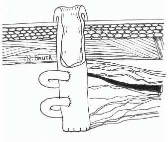 Colostomia Apertura costruita chirurgicamente, in cui una porzione del colon viene portata sulla superficie della cute attraverso la parete addominale.