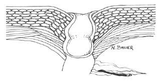 attraverso la parete addominale Prolasso stomale Complicazione della stomia che consiste in una fuoriuscita telescopica dell intestino attraverso lo stoma. Il prolasso può essere di varie lunghezze.