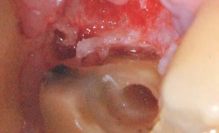 4: Ostectomia micrometrica e plastica radicolare del residuo palatino Fig. 5: Sito implantare con IM2A fino ad identificare tattilmente il pavimento del seno mascellare alveolare.