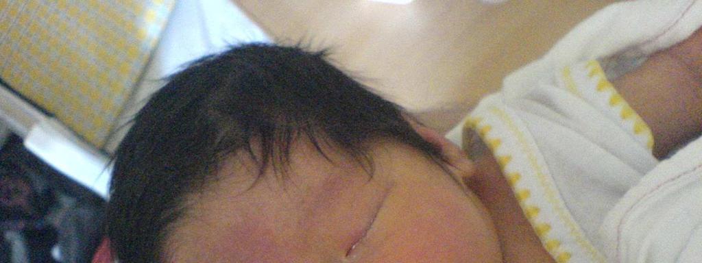 I neonati mostrano spesso un viso edematoso, capelli molto scuri, rime palpebrali oblique e rivolte verso
