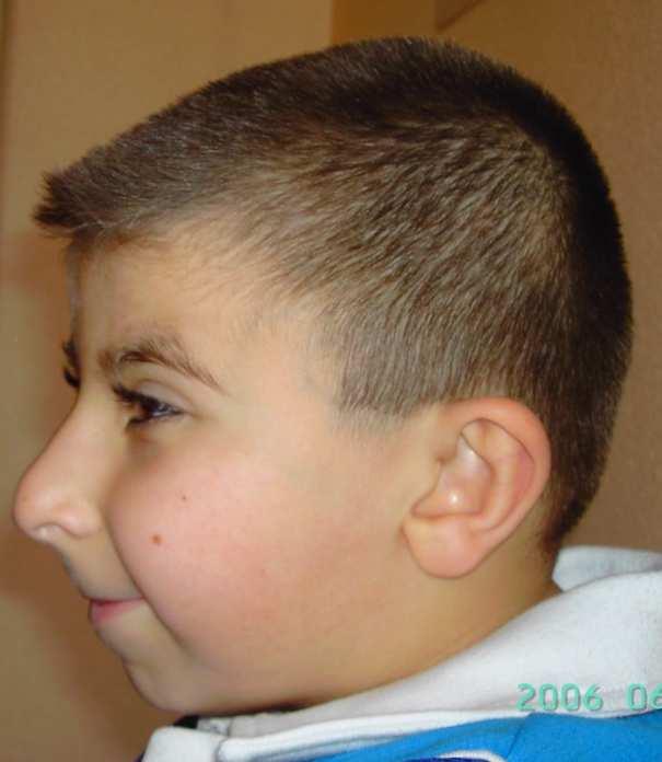 Si notino le sopracciglia arcuate, le rime palpebrali rivolte verso il basso, il naso prominente e con il