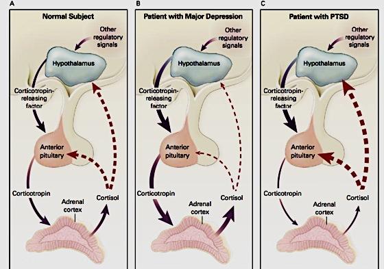 Patients with PTSD (panel C) have low levels of both cortisol and ACTH and an