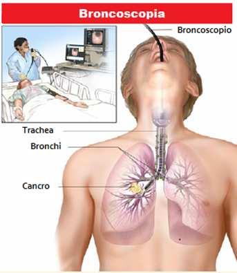 La broncoscopia è un esame con cui è possibile osservare direttamente le vie aeree, cioè laringe, trachea e bronchi,