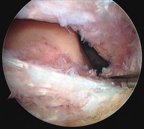 Accessi e ispezione artroscopica 35 A B Fig. 4.