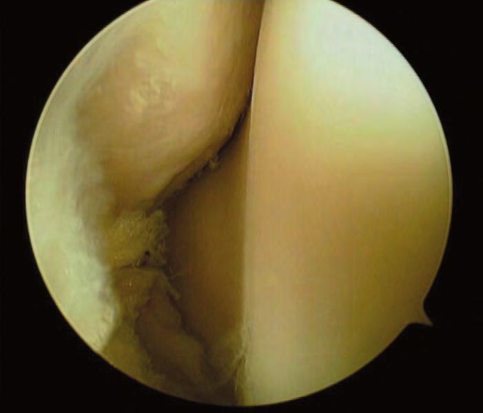 Accessi e ispezione artroscopica 37 Fig. 4.