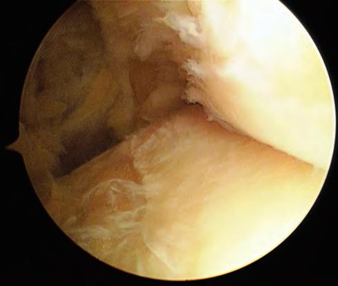 attraverso i portali AM e AL. Il filo guida viene inserito circa 2-3 cm sopra l apice del rispettivo malleolo, sotto eventuale controllo fluoroscopico.