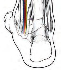7 - Creazione del portale PM: (a) Incisione cutanea medialmente al margine mediale del tendine di Achille,