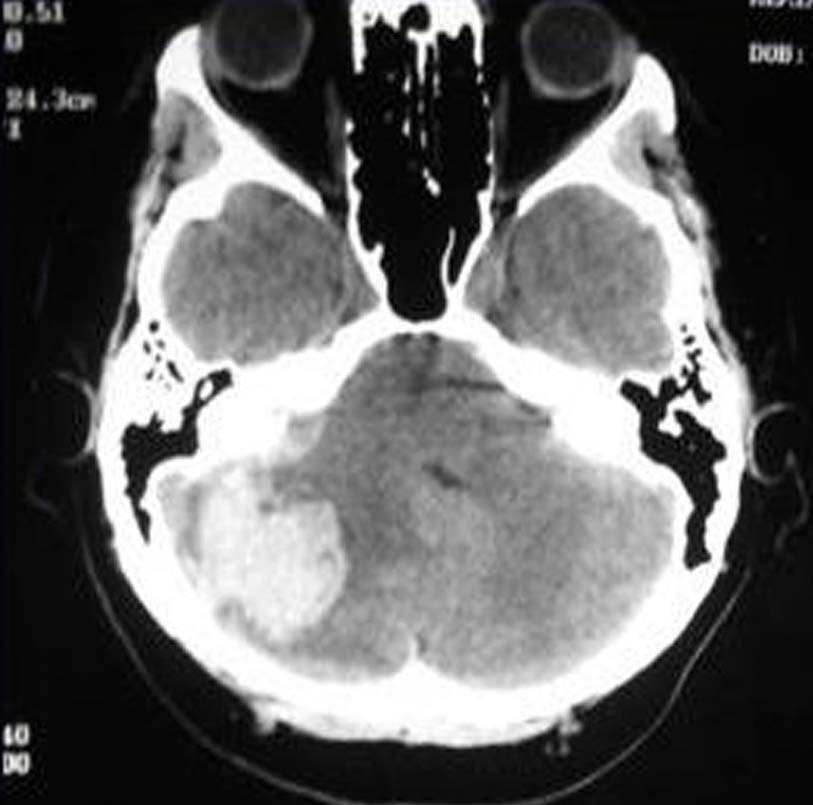 EMORRAGIA CEREBELLARE Cefalea nucale Vertigine oggettiva Atassia Nystagmo bidirezionale che