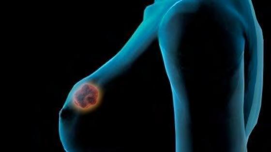 calvario nell'ombra. Più consapevolezza sui percorsi terapeutici di SARA PERO NEL 2017 in Italia sono stati stimati 50.500 nuovi casi di tumore alla mammella infiltranti, cioè maligni.