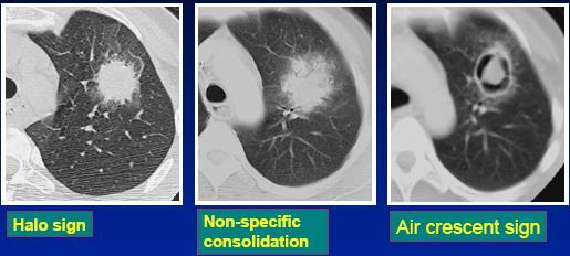 EVOLUZIONE DEI SEGNI RADIOLOGICI DELL ASPERGILLOSI POLMONARE Giorno 0 96% Giorno 0 n.d.