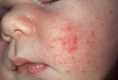 of pediatric skin