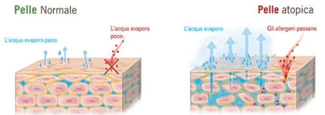 DERMATITE ATOPICA Eczema cronico-recidivante eritematoso pruriginoso con desquamazione e formazione di croste; Disturbo cutaneo più frequente nell infanzia, a partire dai 3 mesi di vita; Spesso primo