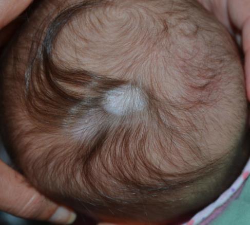 HAIR COLLAR SIGN Anello di ipetricosi posto attorno a lesione di alopecia congenita o