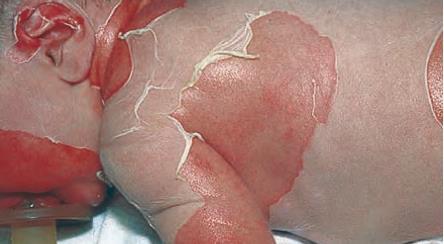 STAPHYLOCOCCAL SCALED SKIN SYNDROME Infezione da ceppi di S.