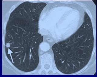 BPCO e tumore del polmone Numerosi studi epidemiologici hanno dimostrato tra BPCO e cancro del polmone L incidenza annuale di K polmonare in pz sembra essere almeno 4 volte quella della