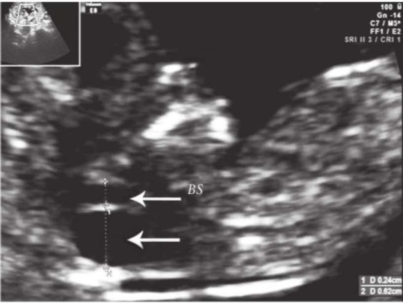 2 spazi, 4V > e CM assente spina bifida malf cistica fossa