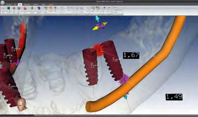 Numerose funzioni e modalità applicative rispondono alle specifiche necessità di implantologi,
