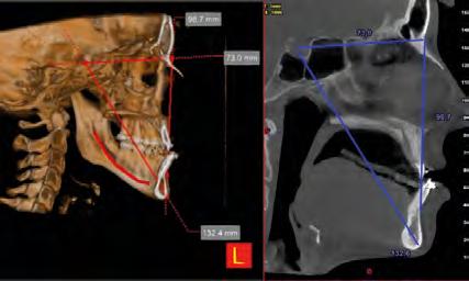 modello osseo del paziente a cui è sovrapponibile un impronta digitale, ottimizzando il