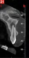 FOV 16 X 18 cm Diagnosi dell intero distretto dento-maxillo-facciale per un accurata progettazione della