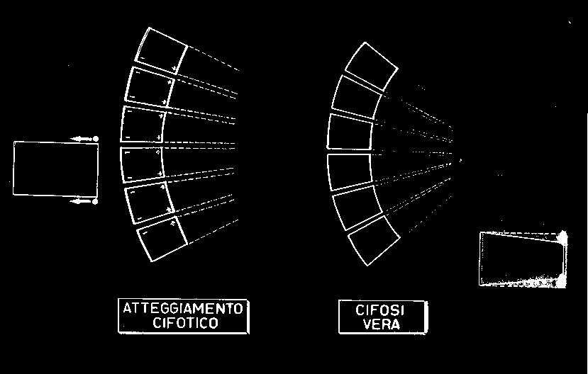 Questo peso e suddiviso in modo disuguale sulle due facce del corpo vertebrale, corrispondente alla concavita ed alla convessita : la pressione diminuisce dal lato della convessita,aumenta dal lato