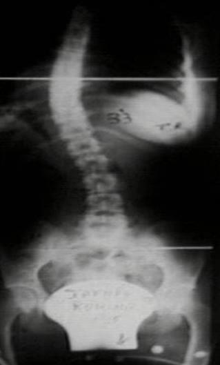 Atteggiamento Paramorfismo Dismorfismo Si verifica quindi una crescita asimmetrica della vertebra che aumenta di piu dal lato convesso (vertebra