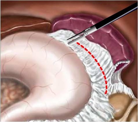 Tecnica chirurgica Sezione del legamento Gastro-splenico dal basso verso