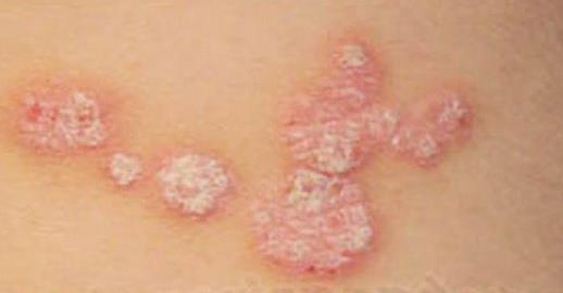 PSORIASI Malattia infiammatoria cronica della pelle, non infettiva né contagiosa, solitamente di carattere cronico e recidivante.