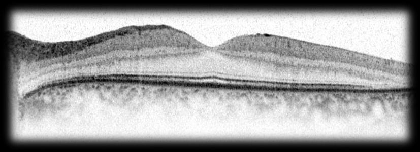 Spectral Domain OCT: esame strumentale che permette di esaminare