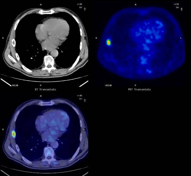 CT [18F]FDG PET Ca polmonare B.C., 61 anni HSR Milano metastasi costale Messa C.