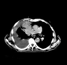 Riduzione del Volume bersaglio CT: Estesa lesione polmonare PET/CT: Atelettasia + area