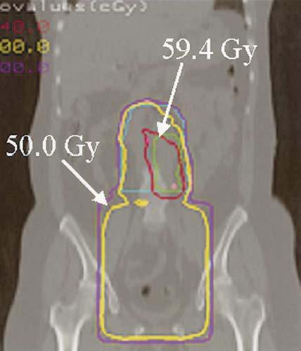 Carcinoma della Cervice uterina FDG-PET e Piano Radioterapico IMRT sotto guida PET permette un trattamento a