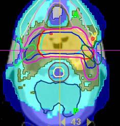 Esempio PTV_LN (54 Gy)+ PTV_LN + +T(66 Gy) + BTV(69Gy) 30