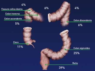 Neoplasie sincrone o metacrone Istologia mucinosa,