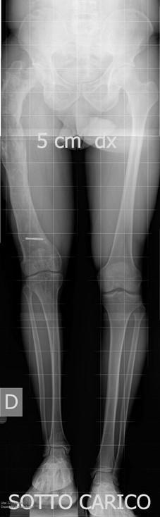 Rx in A/P in carico dall anca alla tibio-tarsica su lastra lunga (Long-Standing X-Ray) Cosa si può valutare?