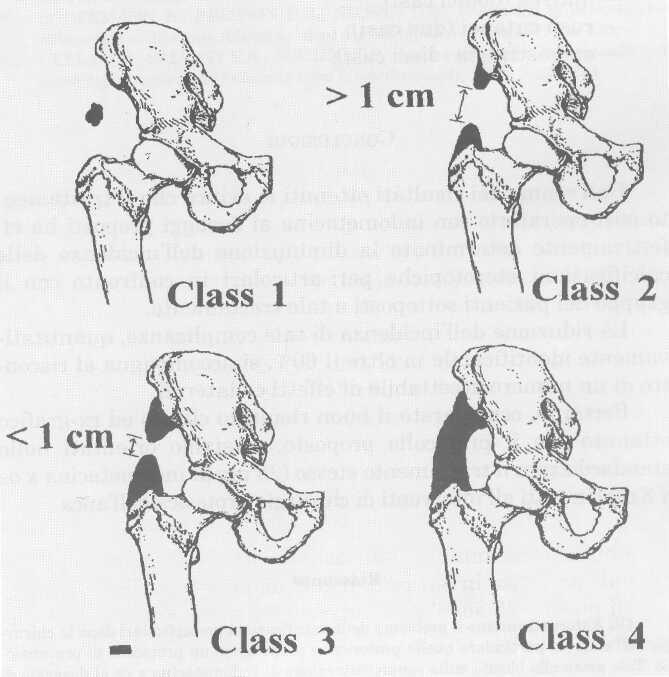 Classificazione di BROOKER per le ossificazioni periprotesiche Classe I: isole di osso all'interno dei tessuti molli intorno all'anca.