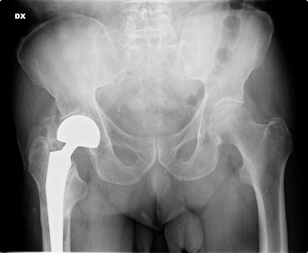 Classe III: meno di 1 cm tra le due estremità. Classe IV: anchilosi ossea dell'anca.