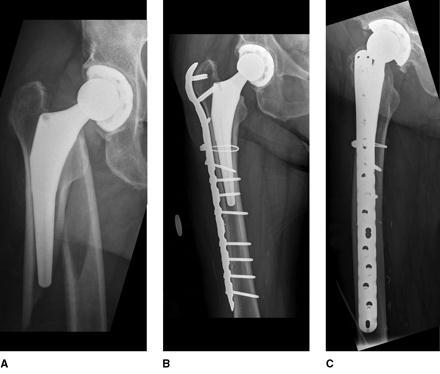 Classificazione di VANCOUVER per le fratture periprotesiche Considera il livello di frattura, la stabilità dell impianto e la qualità ossea e soprattutto è di facile utilizzo per la programmazione