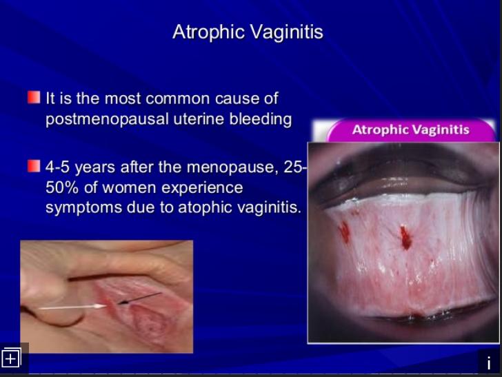 Estrogeni per uso topico Acido ialuronico (Laserterapia)