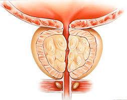 italiana - Tumori della prostata Fonte: A.