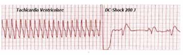 Linea completa di elettrodi multifunzione progettati per defibrillazione, cardioversione sincronizzata, monitoraggio ECG