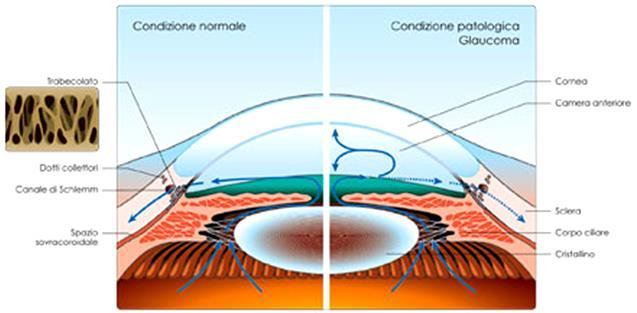 Glaucoma