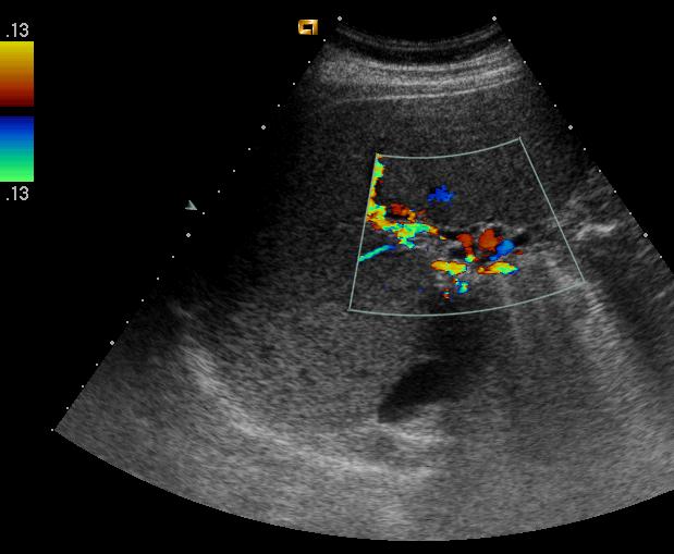 Cavernoma