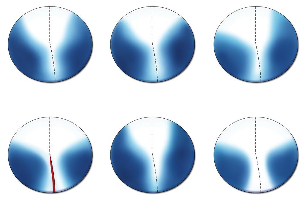 Manuale Pratico di Vision Care uguale la distanza che intercorre dalla croce di centratura per lontano alla piena addizione, l inset varia: è minore per il miope rispetto all ipermetrope.