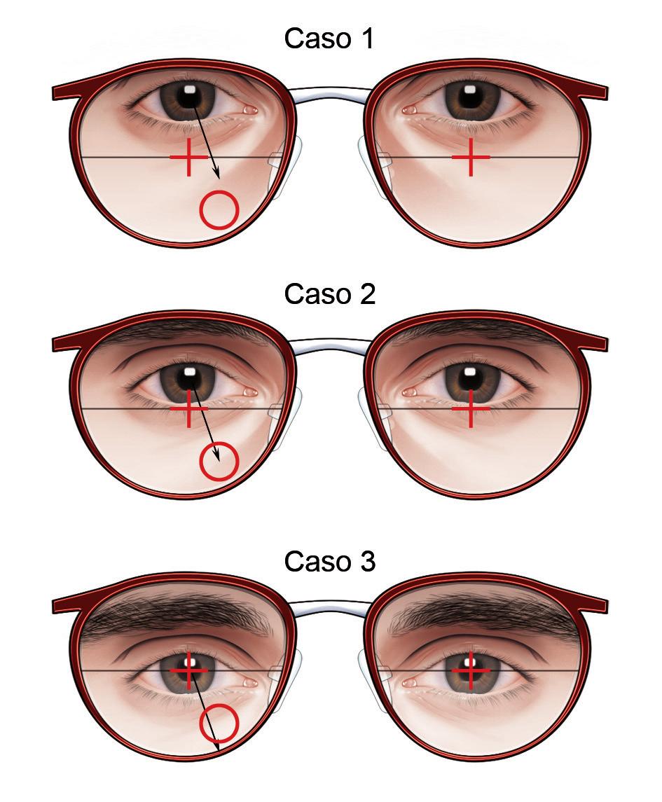 Manuale Pratico di Vision Care Figura 3b.