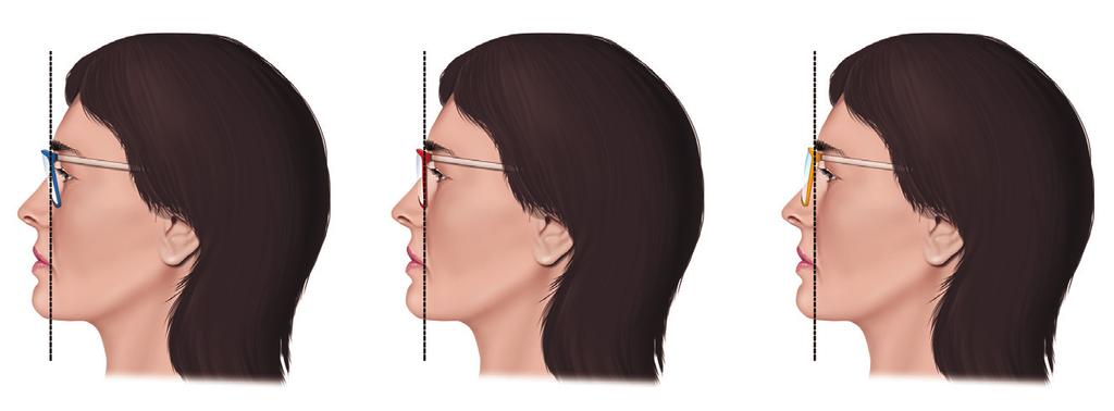Manuale Pratico di Vision Care Rilevamento dell angolo pantoscopico L angolo pantoscopico (inteso ad occhiale calzato sul volto) è l angolo che si forma tra il frontale della montatura, quando la