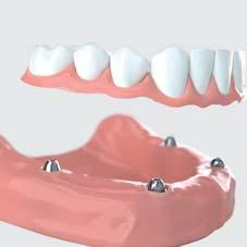 3. SOSTITUZIONE DI TUTTI I DENTI (PROTESI FISSA) VARIANTE 1: Anche nella sostituzione di tutti i denti vengono utilizzati impianti