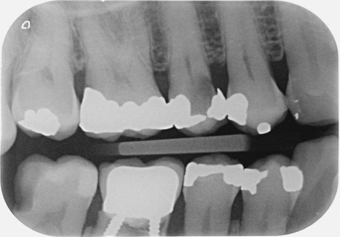 superiore di destra del paziente, confermate dalla radiografia Bite Wing. RX Bite Wing a destra.