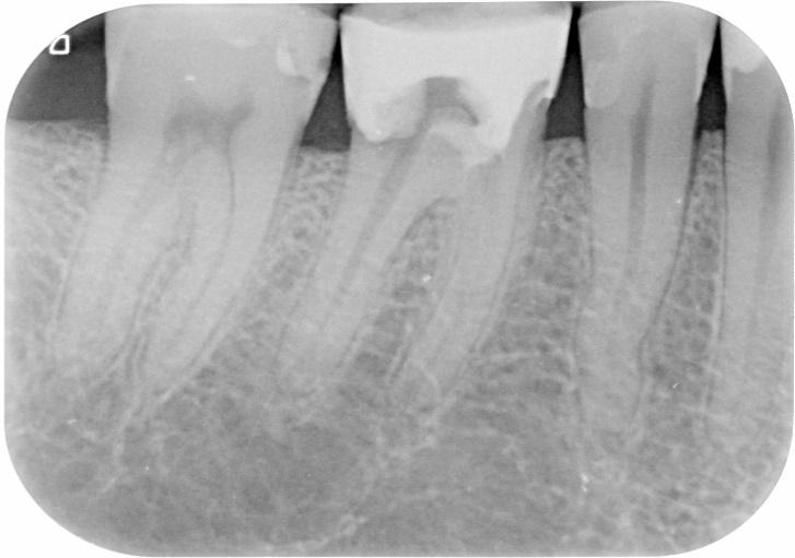 Sopra. La radiografia periapicale, relativa al molare inferiore di sinistra della precedente RX Bite Wing.