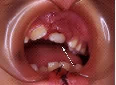 Trauma dentale da impatto