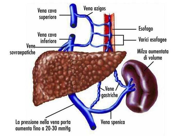 IPERTENSIONE PORTALE Fisiopatologia Pressione portale: resistenze intraepatiche x flusso portale In corso di cirrosi progressivo aumento pressione portale: 1.